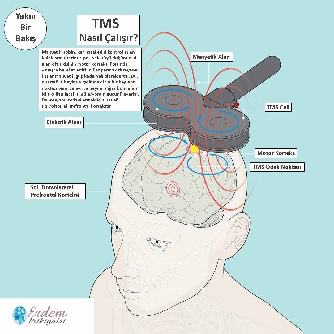 transkranial manyetik uyarim tedavisi tms yineleyici transkranial manyetik uyarim ytmu transkranial manyetik uyarim tedavisi tms yineleyici transkranial manyetik uyarim ytmu